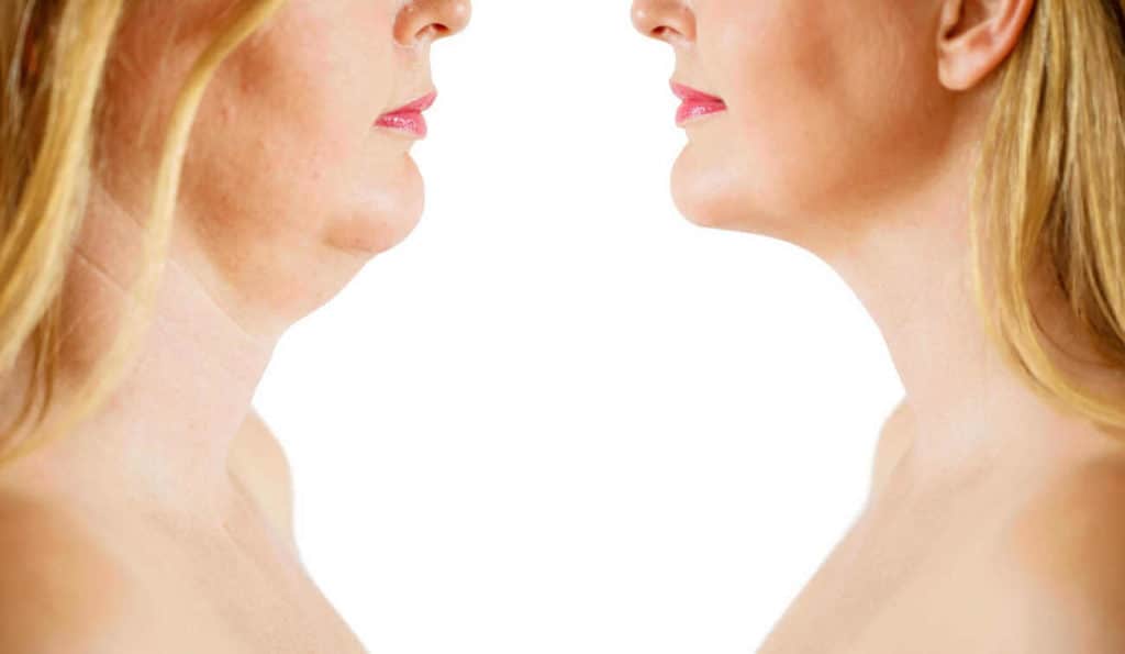 Double Chin treatment Shipston-on-Stour before and after results