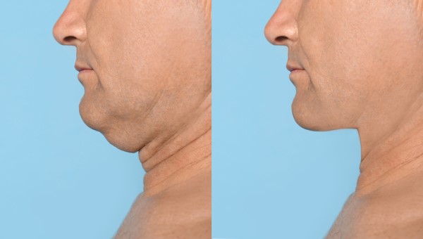 Which Non-Surgical Treatments Work Best for Jowls and Loose Skin Shipston-on-Stour?
