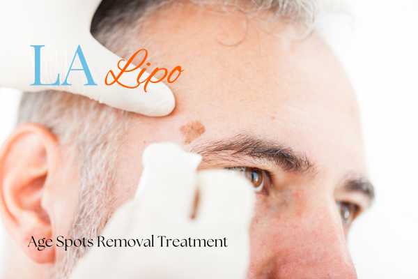 What Are the Most Effective Treatments for Age Spots Shipston-on-Stour?