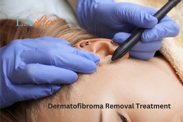 Dermatofibroma Removal Treatment Shipston-on-Stour