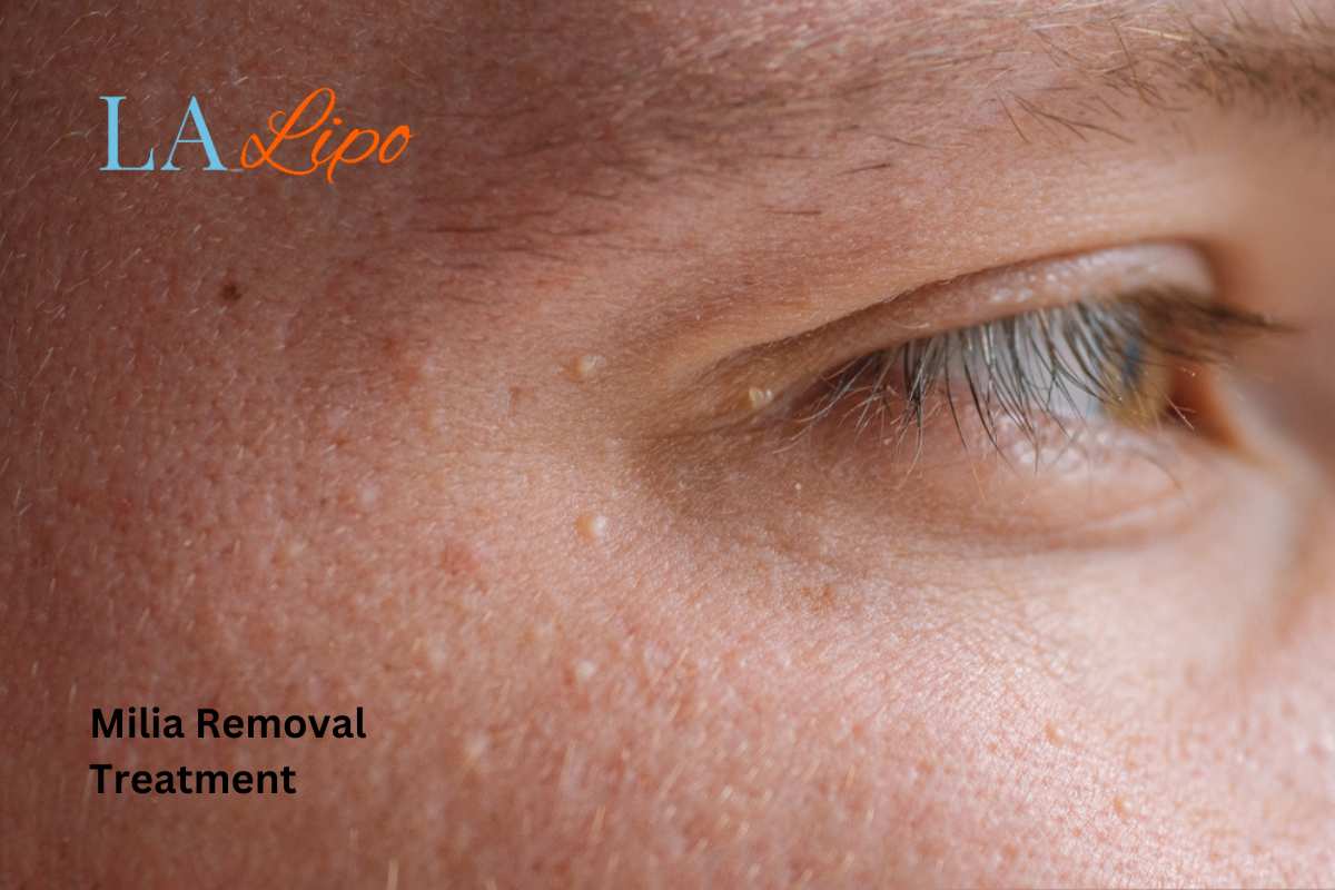 Cryopen Milia Removal: Is It the Easiest and Safest Option Shipston-on-Stour?