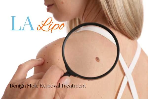 Woman having her inspection of blemish before mole removal Shipston-on-Stour