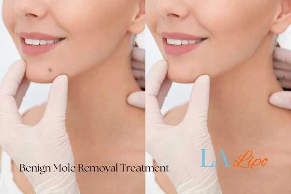 woman's before and after mole removal Shipston-on-Stour results