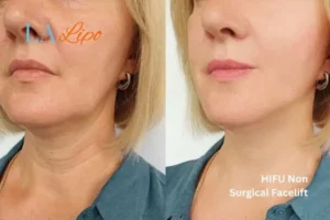 hi-fu for wrinkles Shipston-on-Stour before and after results
