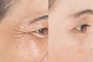 Before and after results of woman - HI-fu wrinkles reduction treatment Shipston-on-Stour