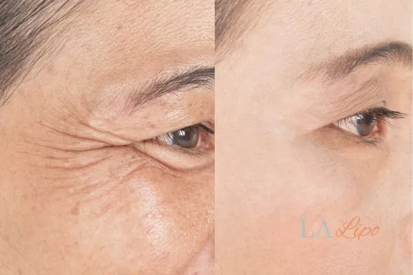 Before and after results of woman - HI-fu wrinkles reduction treatment Shipston-on-Stour