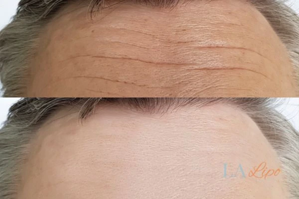 results of HIFU Shipston-on-Stour on mans forehead to help reduce lines and wrinkles