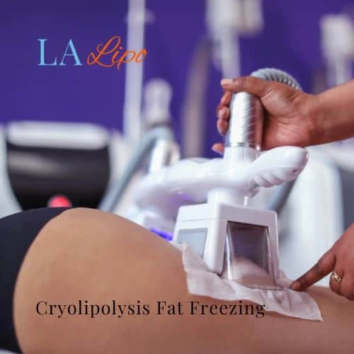 fat freezing - Cryolipolysis Shipston-on-Stour