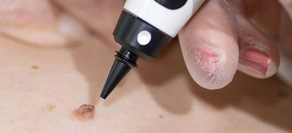 skin tag removal using cryopen Shipston-on-Stour