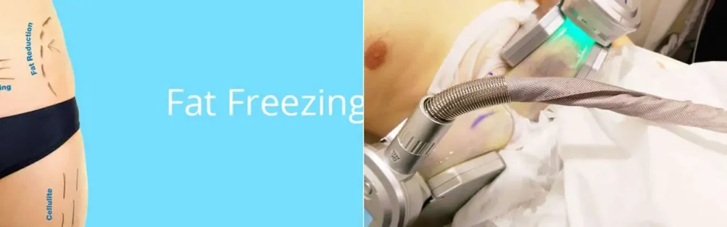 Fat freezing Shipston-on-Stour on multiple areas of the body