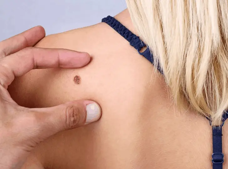 woman having mole removal Shipston-on-Stour consultation before treatment.