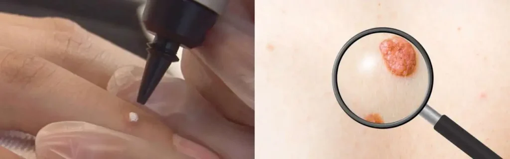 Cryopen for mole removal Shipston-on-Stour - speak to our team today!