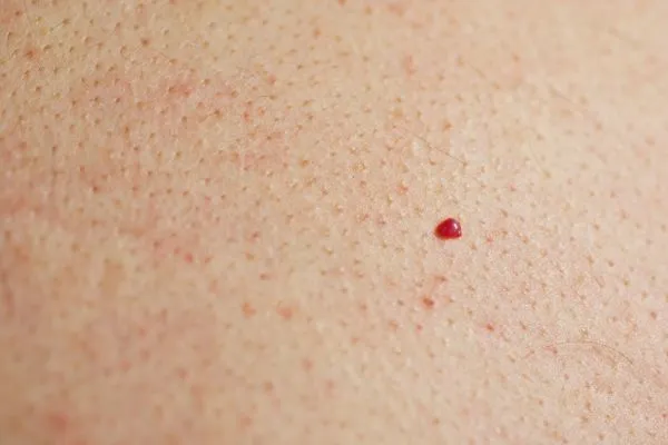 close up of a cherry angioma Shipston-on-Stour