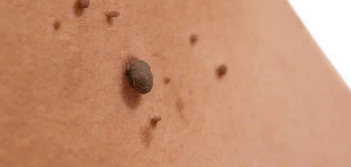 image of a skin tag Shipston-on-Stour