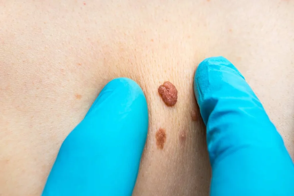 Consultant examining a skin tag Shipston-on-Stour