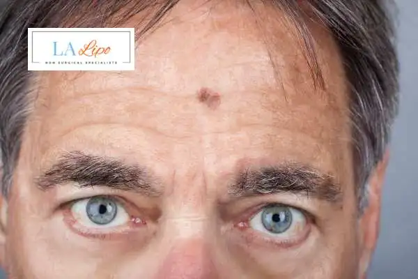 Solar Lentigo Removal Shipston-on-Stour image of man with mark on his forehead