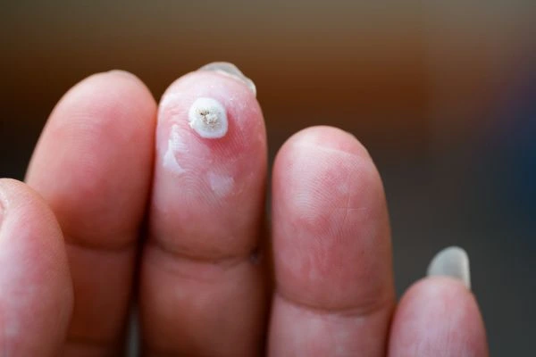 wart on person finger - cryotherapy to treat from LA LIPO Shipston-on-Stour