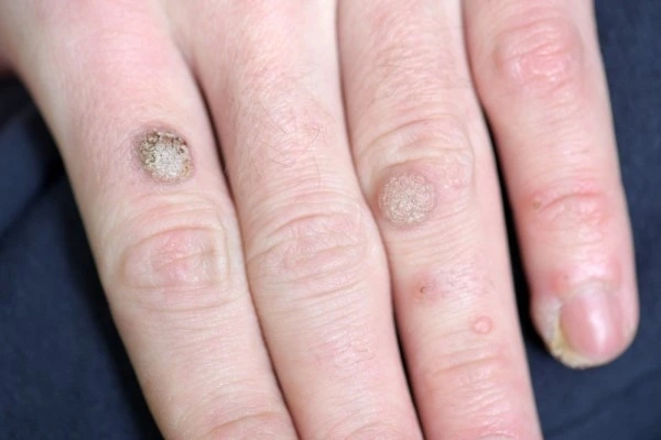 photo of warts on person hand - see wart removal Shipston-on-Stour from LA LIPO