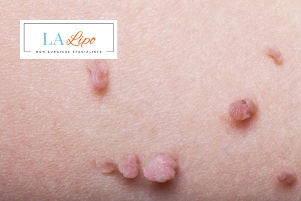 Does cryopen skin tag removal Shipston-on-Stour hurt? Find out now call our team today!
