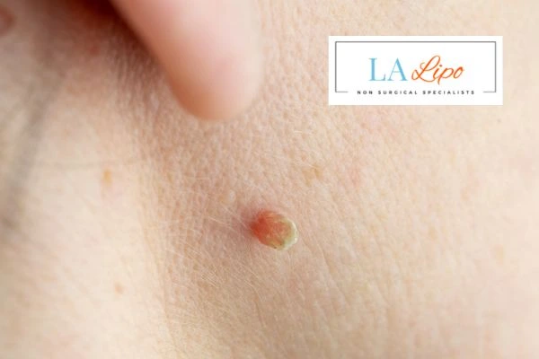 Book skin tag removal Shipston-on-Stour today speak to our team now!