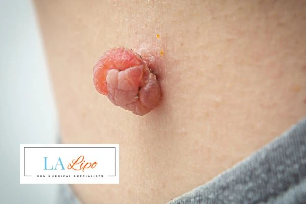 Interested in skin tag removal Shipston-on-Stour? Concerned about the pain? Find out more today!