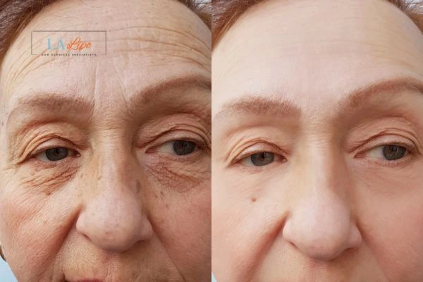 The powerful benefits of Morpheus8 Treatment Shipston-on-Stour - Call Our team today!