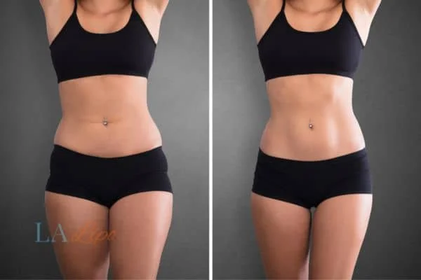 before and after results of non-surgical treatment to help a woman's body image and mental health Shipston-on-Stour