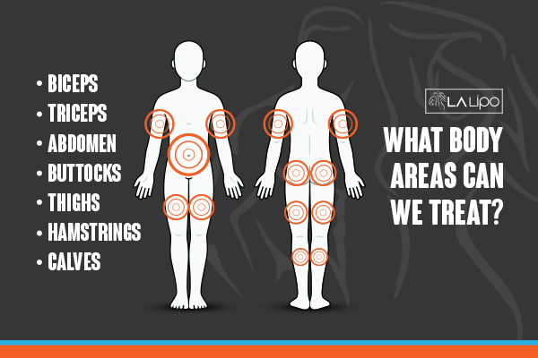Diagram to show areas you can have LA-EMS Body Sculpting Treatment Shipston-on-Stour