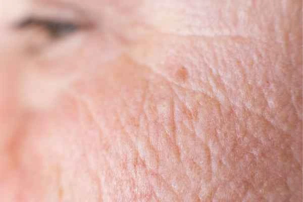 close up picture of a woman's face showing an age spot Shipston-on-Stour