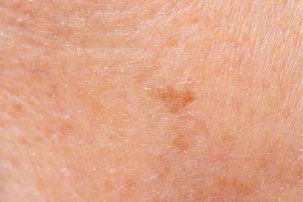 close up picture of age spots Shipston-on-Stour
