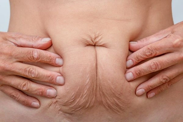 Image of a woman's stomach with loose skin - example of skin tightening Shipston-on-Stour options