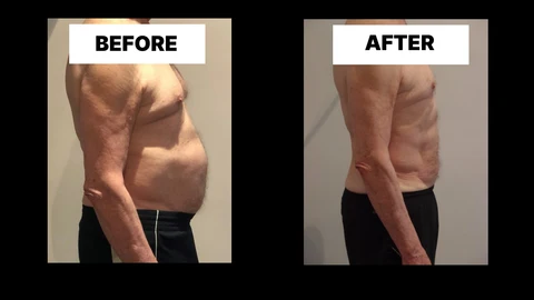 What Symptoms Can Diastasis Recti Cause in Men? Weak Core, Back Pain and Poor Posture Shipston-on-Stour